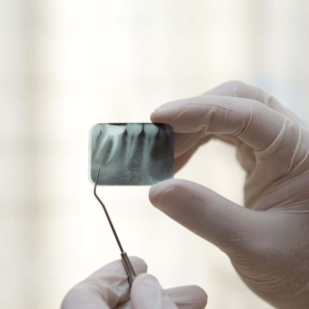 Devitalizzazione dente a Sora - Fabi Odontoiatria